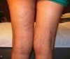 Doctor for varicose veins and preganancy p02 spider veins after pregnancy