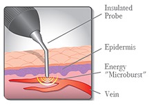 VeinGogh Procedure Top Varicose Vein Doctor NYC p01