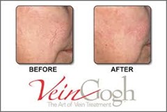 VeinGogh Procedure Top Varicose Vein Doctor NYC p02