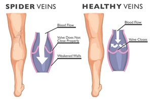 Spider Veins