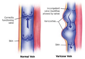 Best Varicose Vein Surgery in NYC