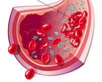 Venous thrombosis