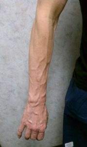 Varicose Veins