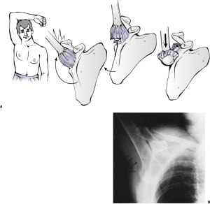 Vein Damage