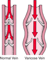 Bleeding Varicose Veins