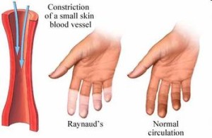 raynauds_disease