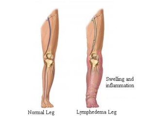 Lymphedema