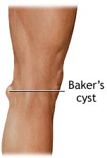 Baker's Cyst