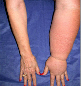 Lymphedema