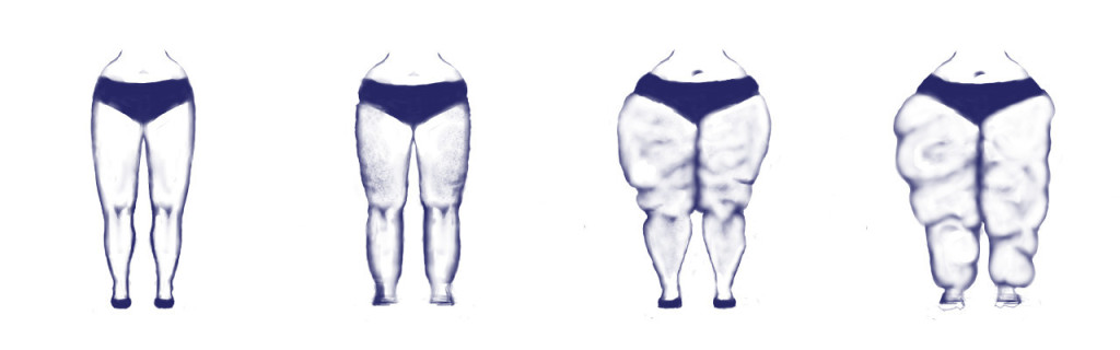 Lipedema