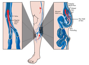 Ambulatory Phlebectomy