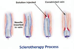 reticular veins