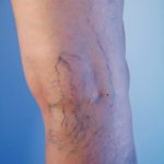 varicose veins