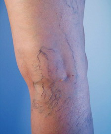 varicose veins