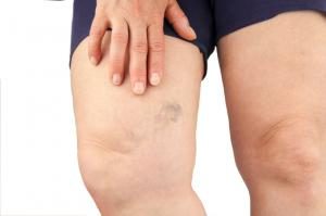 When Is Treatment for Varicose Veins Necessary?