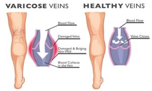 varicose veins