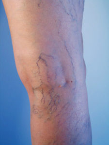 Telangiectasia Varicose Veins