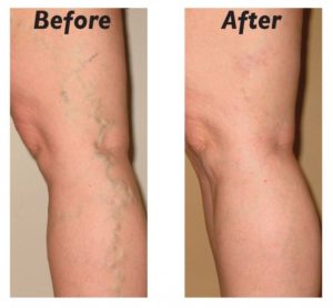 Telangiectasia Varicose Veins