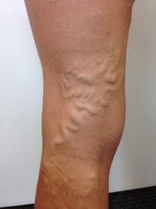 Varicose Veins