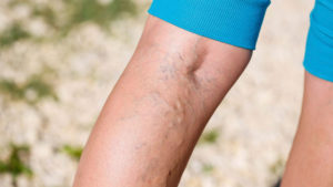 Varicose Veins