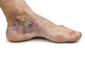 What Diseases Can Cause Varicose Veins?