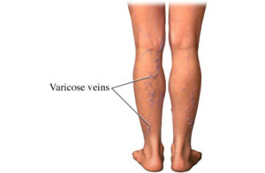 What Diseases Can Cause Varicose Veins?