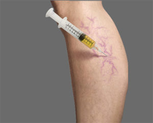 What Are the Side Effects of Sclerotherapy?
