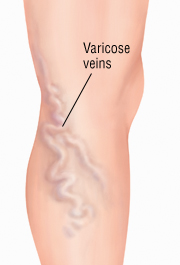 The Most Common Symptoms of Varicose Veins