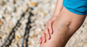 The Most Common Symptoms of Varicose Veins