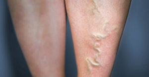 Are Varicose Veins Dangerous?