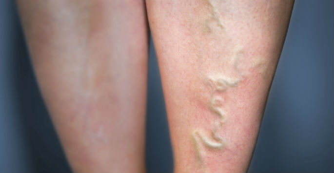 What Causes Dark Spots on Your Legs and How Treat Them? - Downtown Vein &  Vascular