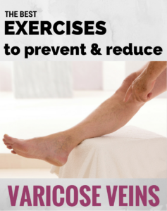 Exercises for Varicose Veins