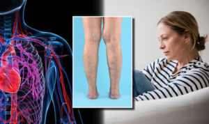 Can Stress Cause Varicose Veins?