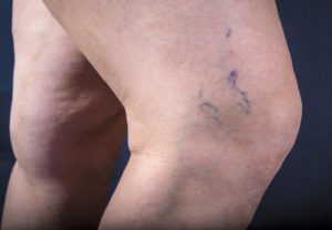 varicose veins