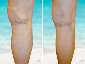 varicose veins