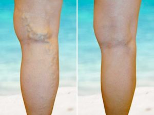 varicose veins