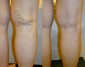 varicose veins