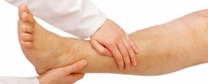 varicose veins