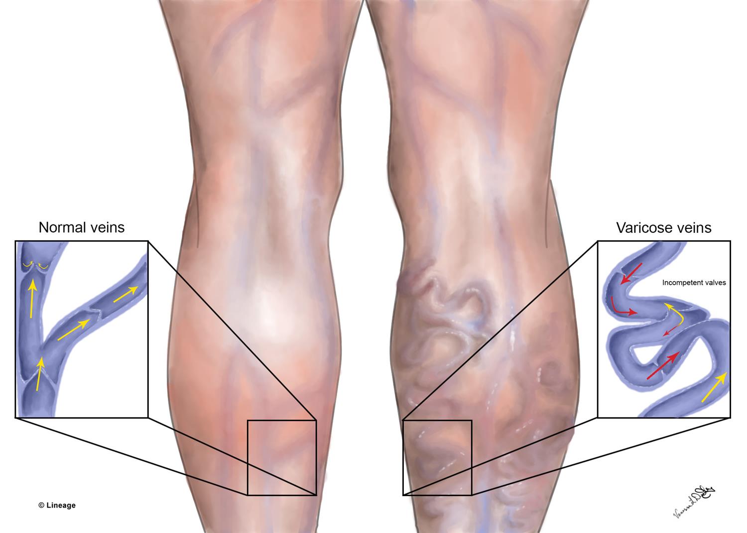 Are Varicose Veins Hereditary?