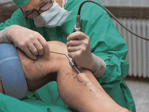 Varicose Veins Surgery