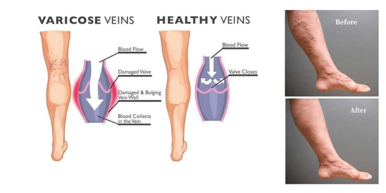 What Does Varicose Veins Surgery Involve Top Varicose Vein Treatment NYC