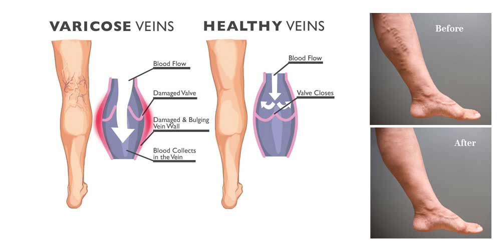 What Does Varicose Veins Surgery Involve? Top Varicose Vein Treatment NYC