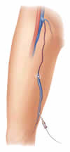 endovenous-laser-ablation