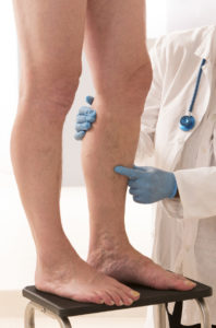 Varicose veins