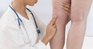 Varicose Veins 