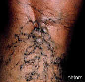 sclerotherapy-before-pic