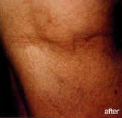 sclerotherapy-afer-pic